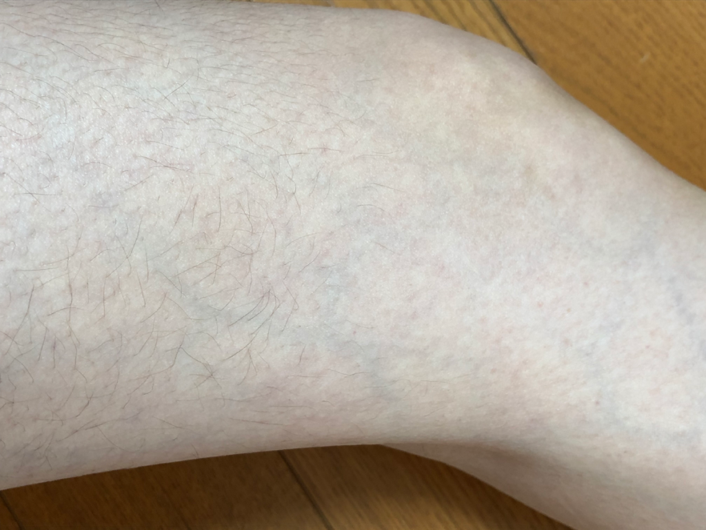 部分脱毛で出来た境目